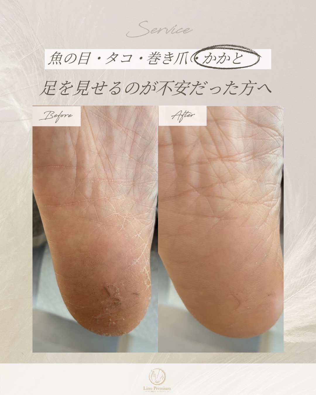 乾燥したかかとをケアする前と後の比較写真