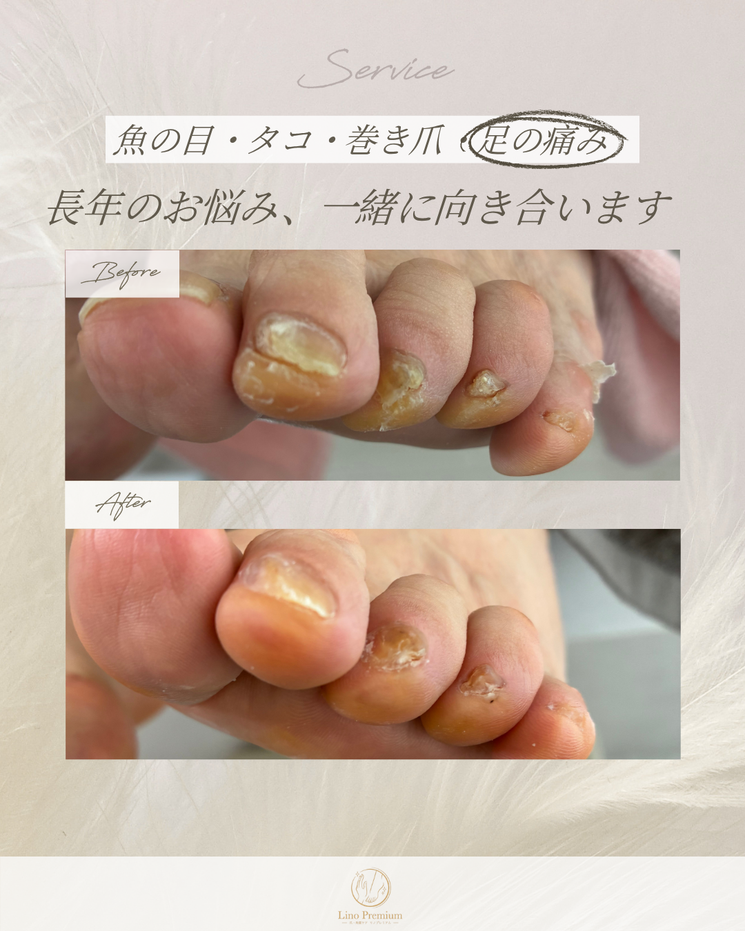 足指の爪の状態をケアする前と後の比較写真