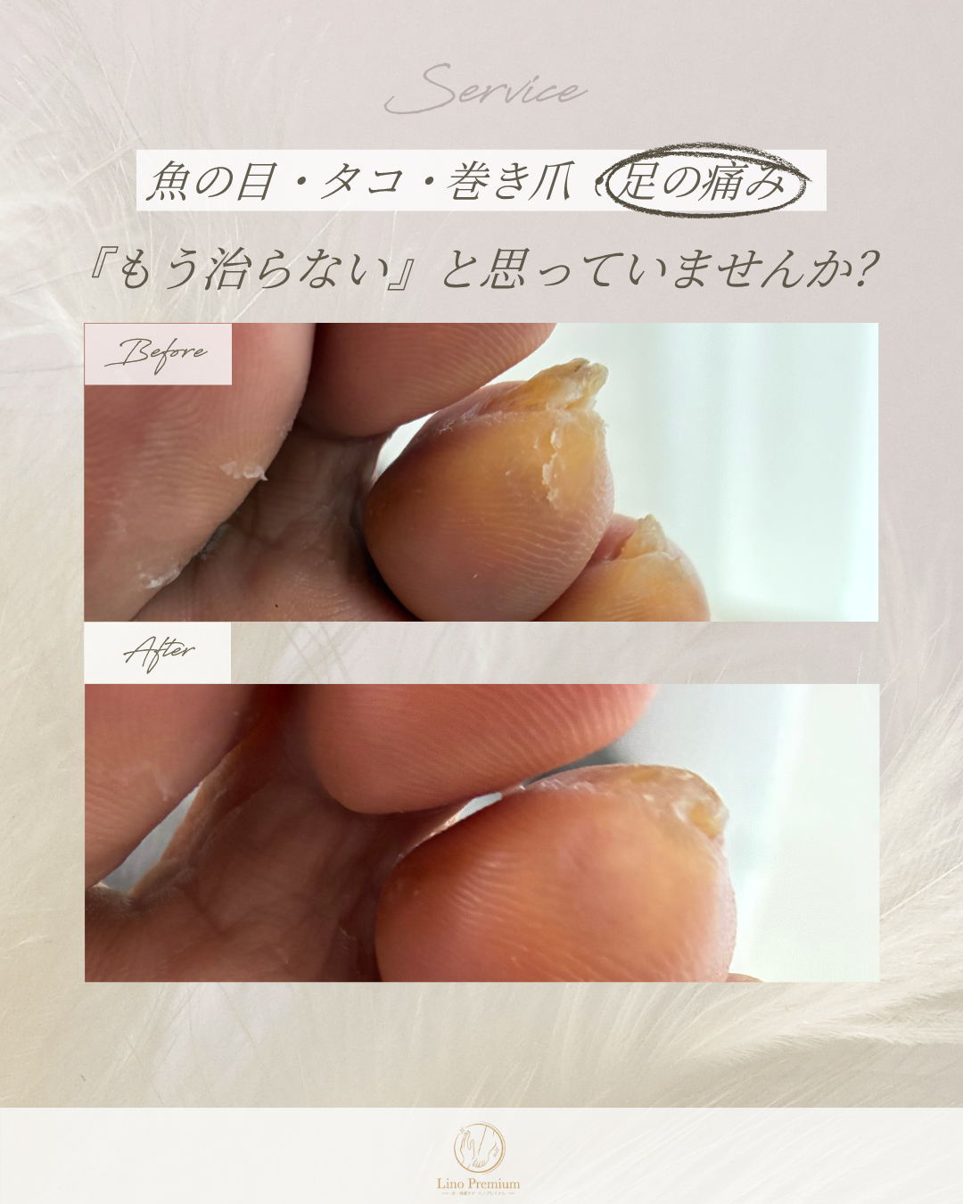 足指にできた硬い角質をケアする前と後の比較写真