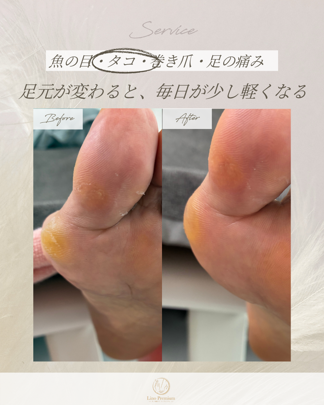 かかとから足裏にかけてのタコのケア事例