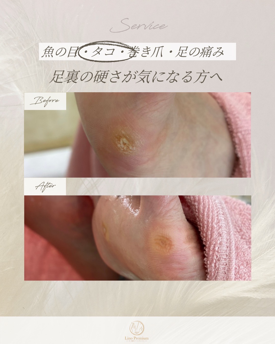 足裏のタコをケアする前と後の比較写真