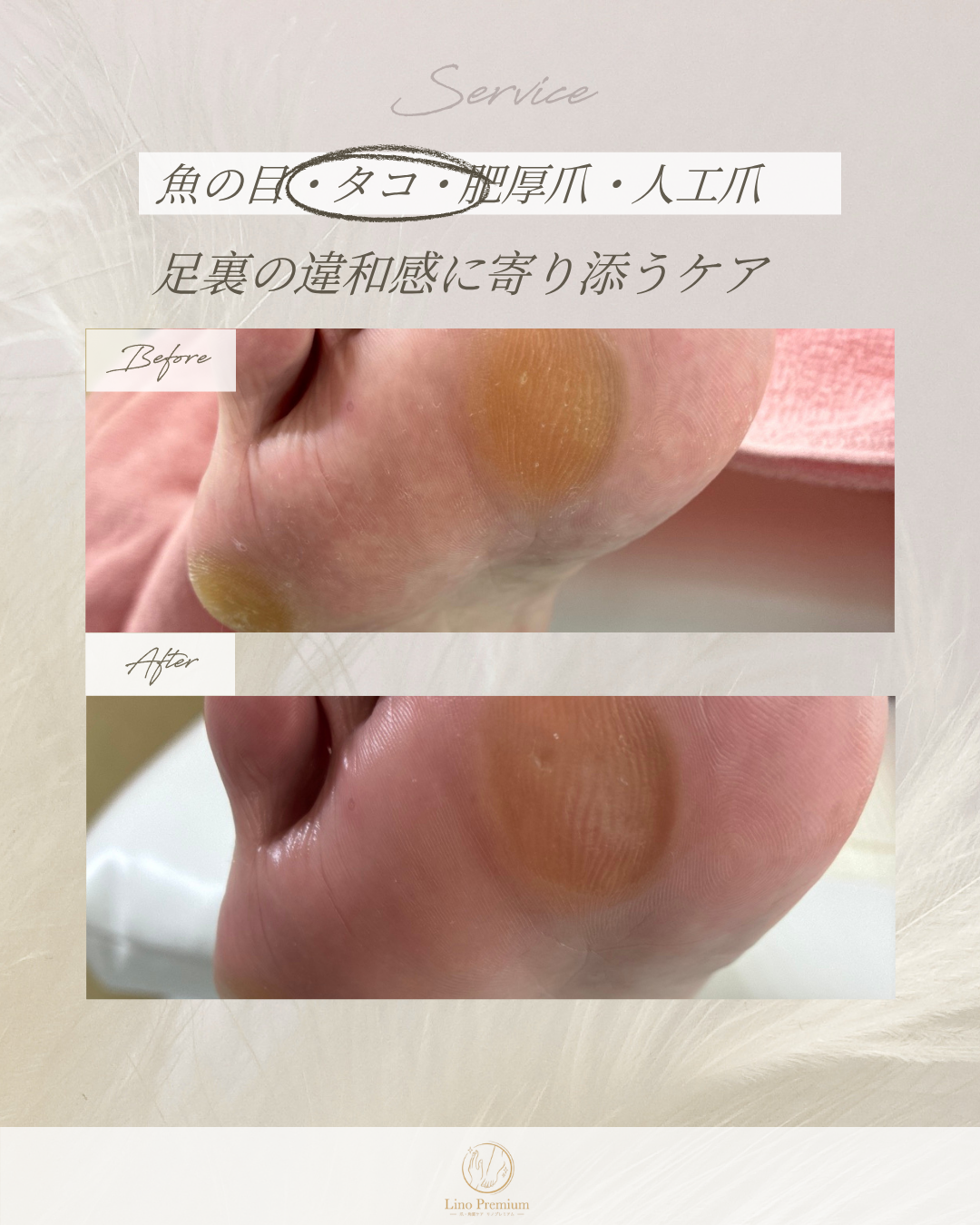 足裏のタコをケアする前と後の比較写真（別のお客様の事例）