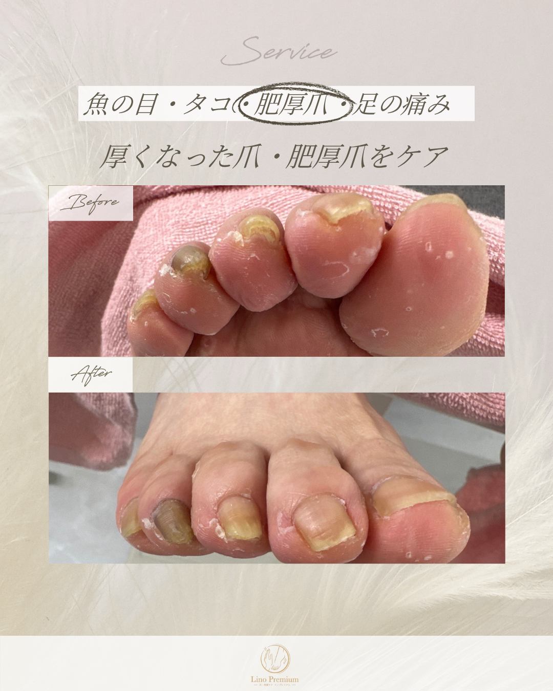 肥厚した爪のケア事例