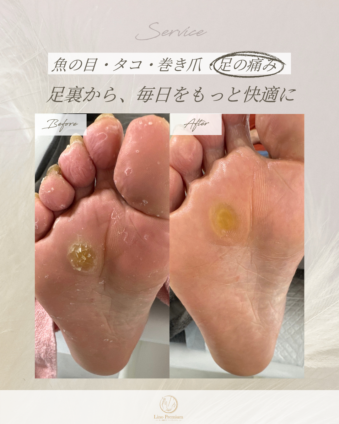 足裏にできた魚の目のケア事例