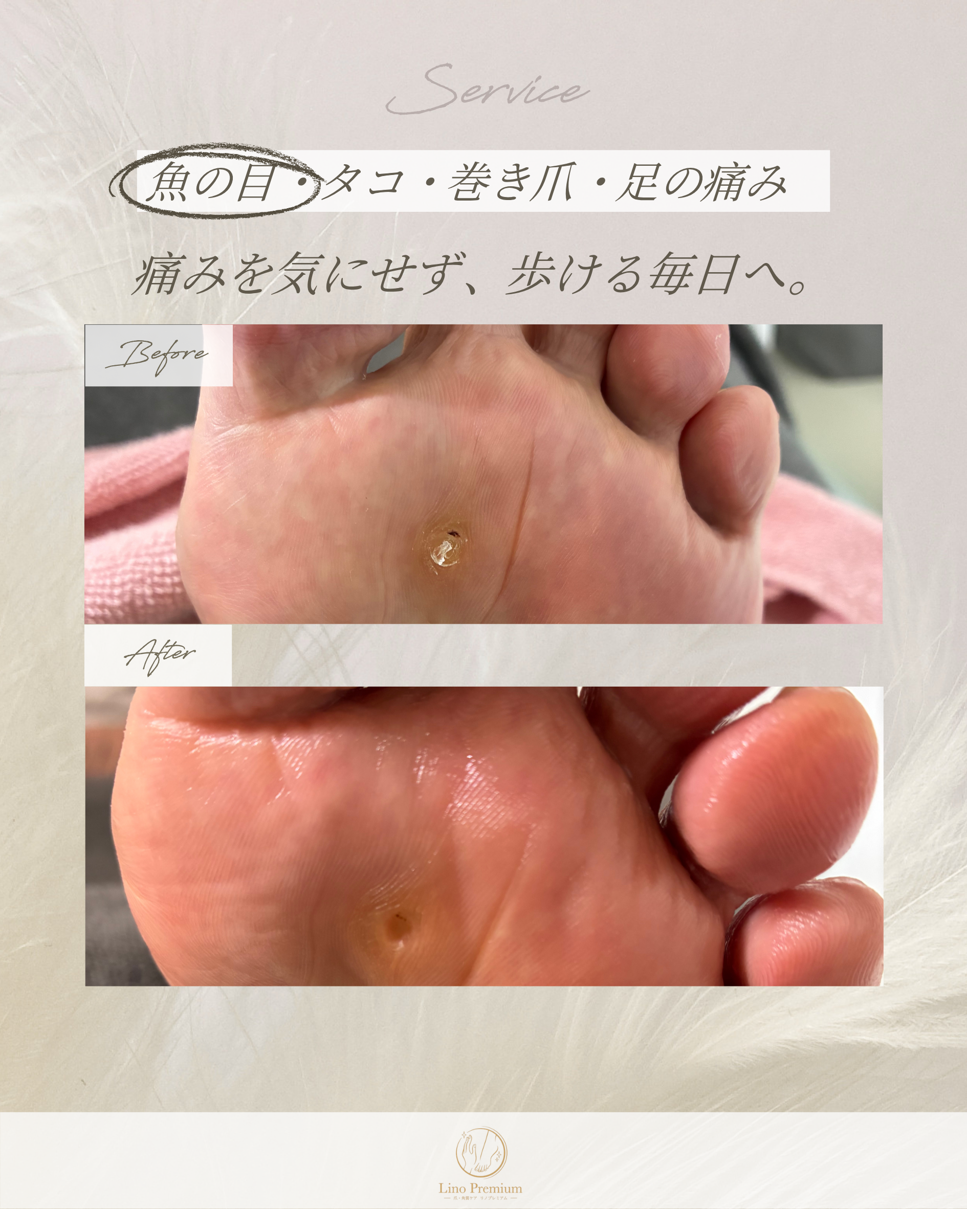 足裏にできた魚の目をケアする前と後の比較写真（別のお客様の事例）