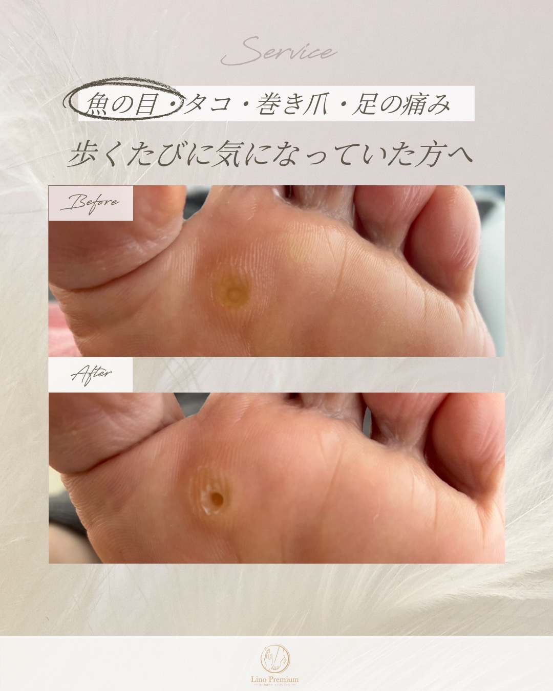 足裏にできた魚の目をケアする前と後の比較写真