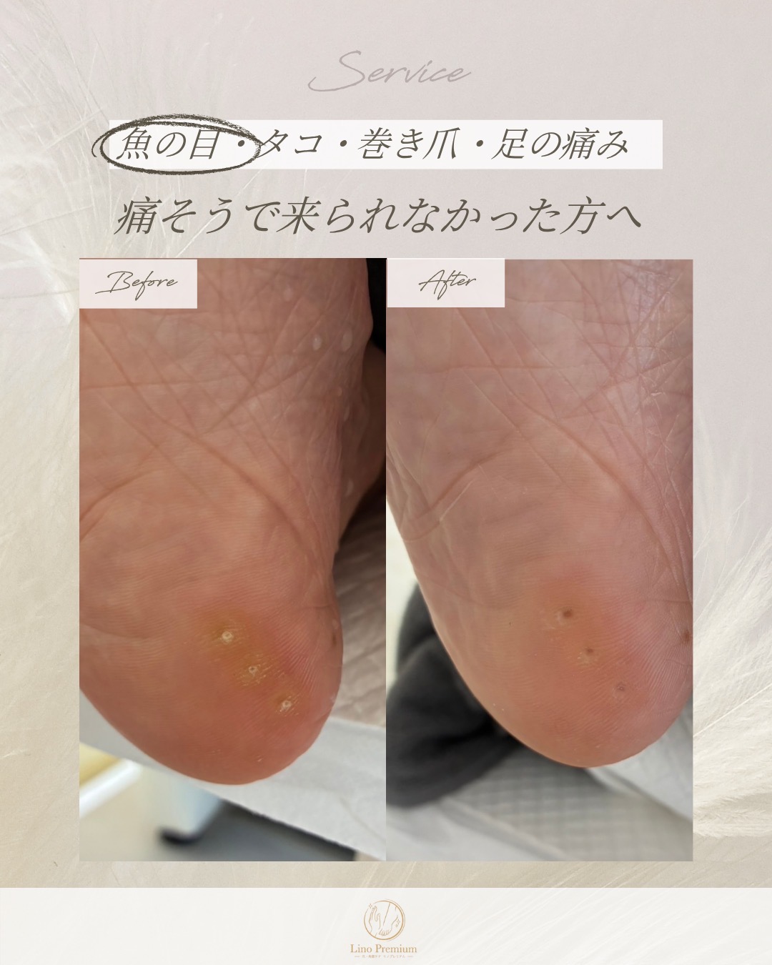 足裏にできた魚の目をケアする前と後の比較写真（別のお客様の事例）